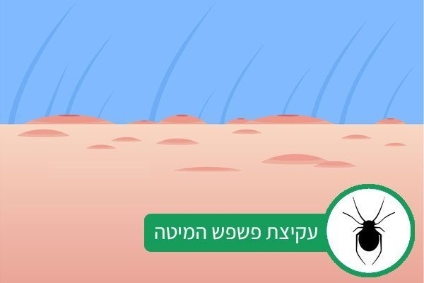 עקיצת פשפש המיטה אילוסטרציה